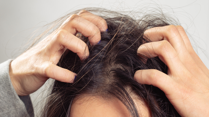 Da đầu gàu – ngứa kéo dài: 6 nguyên nhân ít ai ngờ tới khiến vấn đề trở nặng- Ảnh 3.