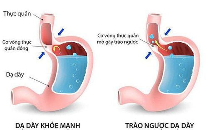 Những việc nên và không nên làm khi mắc trào ngược dạ dày 