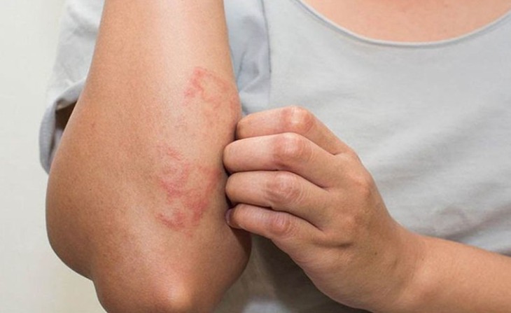 Viêm da cơ địa dễ tái phát khi thời tiết thay đổi - Ảnh 2.