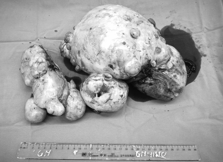 Bất ngờ phát hiện u buồng trứng gần 3kg sau chấn thương sọ não- Ảnh 2.