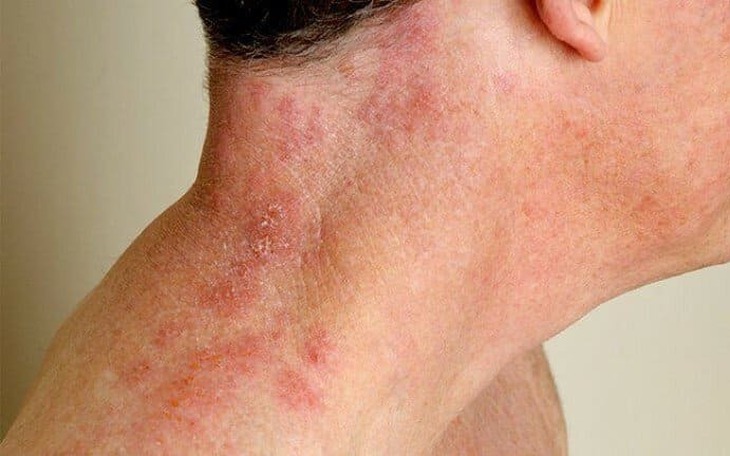 Lý do người lớn tuổi dễ mắc bệnh zona thần kinh
