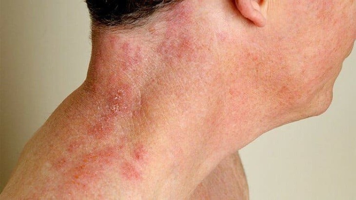 Tiêm phòng vaccine zona có thể là biện pháp hiệu quả chống lại chứng mất trí nhớ- Ảnh 1. Tiêm phòng vaccine zona có thể là biện pháp hiệu quả chống lại chứng mất trí nhớ- Ảnh 1.