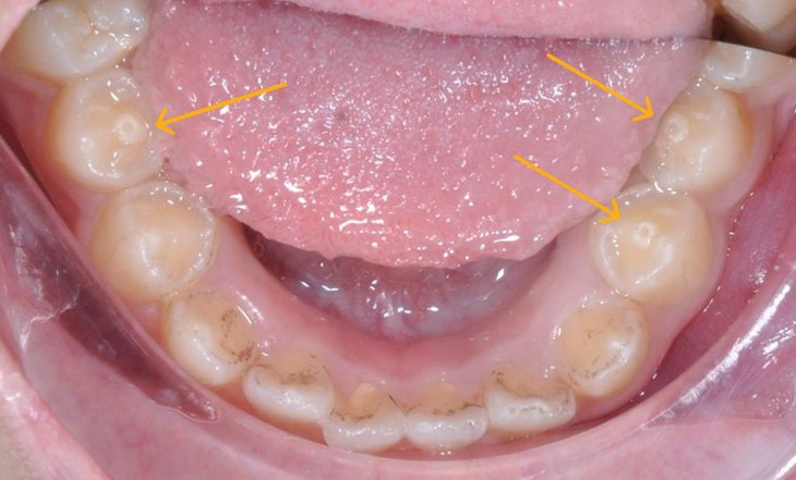 Răng có núm phụ – nguy cơ biến chứng nếu không điều trị kịp thời- Ảnh 1.