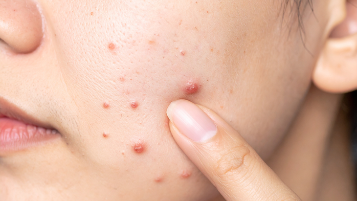Vì sao phụ nữ mãn kinh vẫn bị mụn?- Ảnh 1.