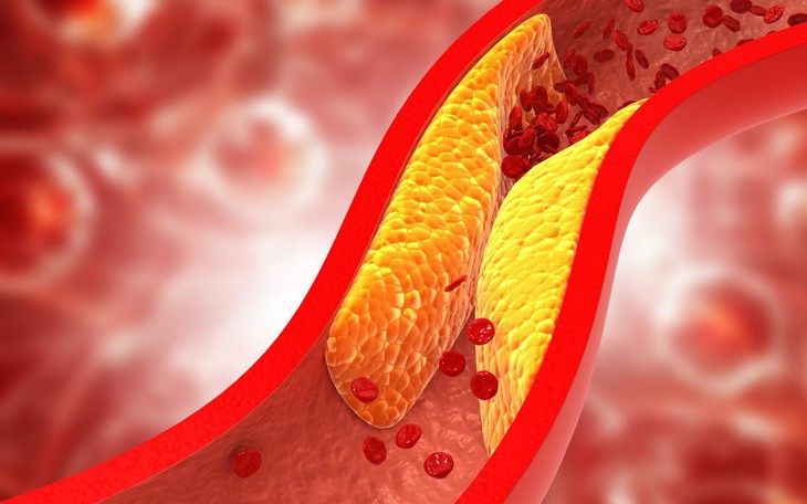 Cholesterol cao không chỉ do ăn dầu mỡ, nguyên nhân chính thường bị bỏ qua- Ảnh 1.