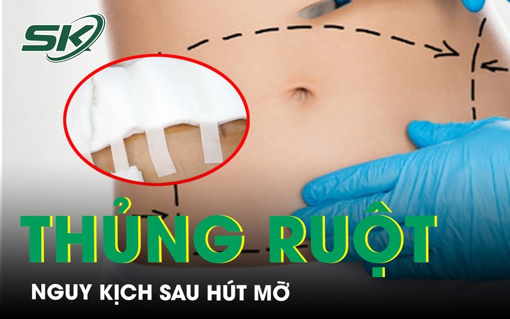 Người phụ nữ thủng ruột nguy kịch sau hút mỡ