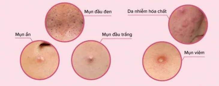 Cách tẩy da chết an toàn cho người da dầu mụn- Ảnh 1.