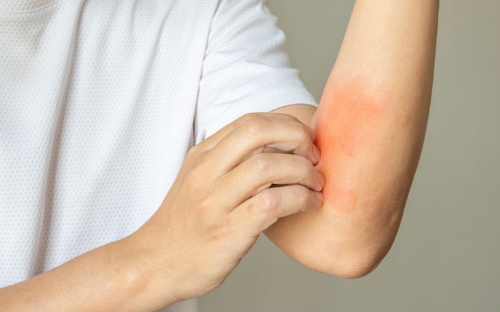 Dị ứng thức ăn làm sao để nhận biết?