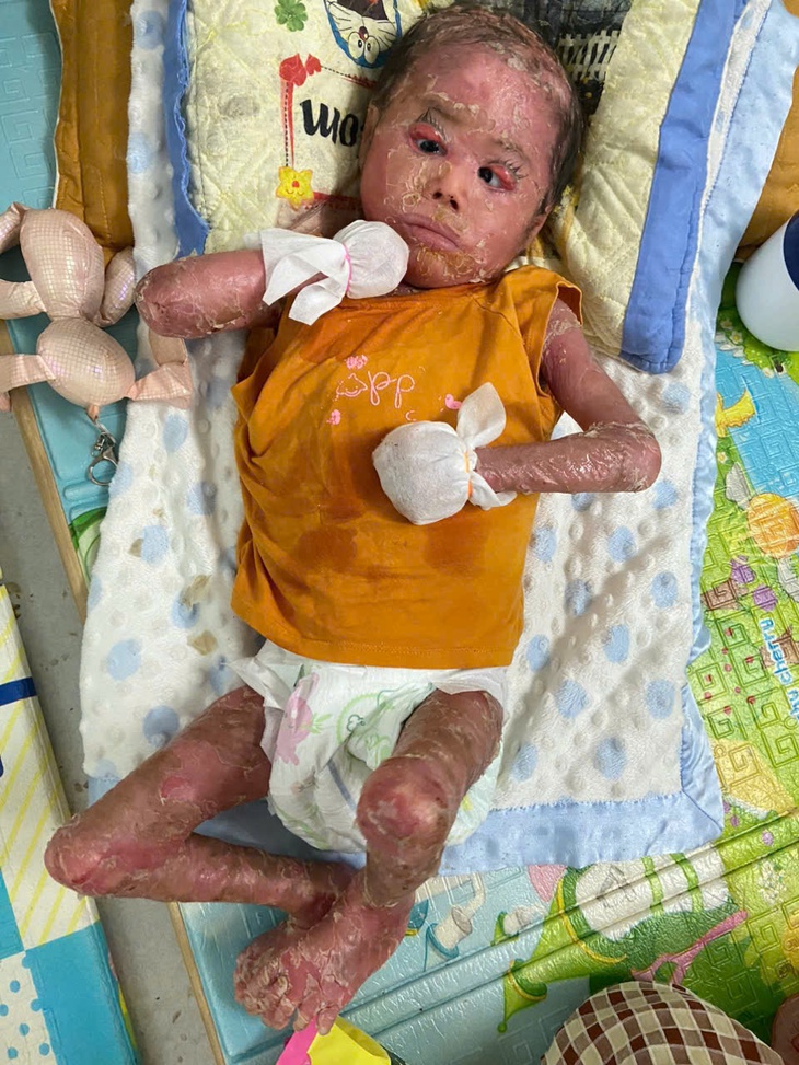 Xót xa bé trai 2 tuổi da toàn thân bong tróc vì bệnh quái ác, mẹ chỉ mong có đủ tiền mua băng gạc cho con- Ảnh 1.