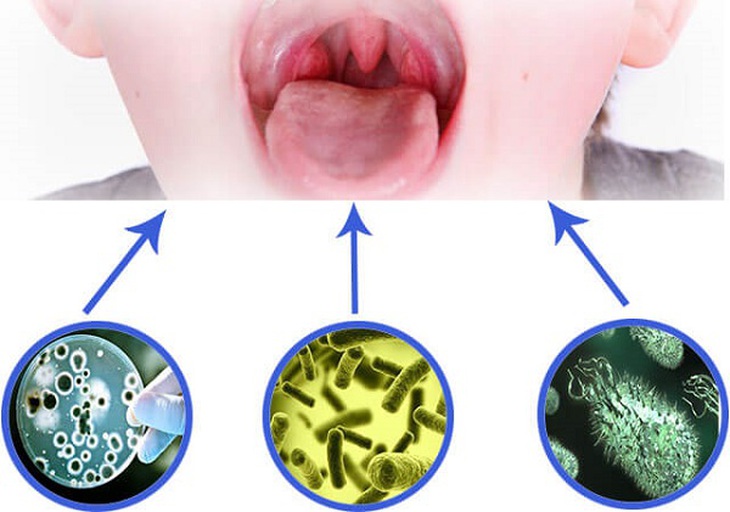 Viêm mũi họng cấp là viêm cấp tính niêm mạc vùng mũi và họng, thường kết hợp với viêm Amidan, VA,… Ảnh minh họa