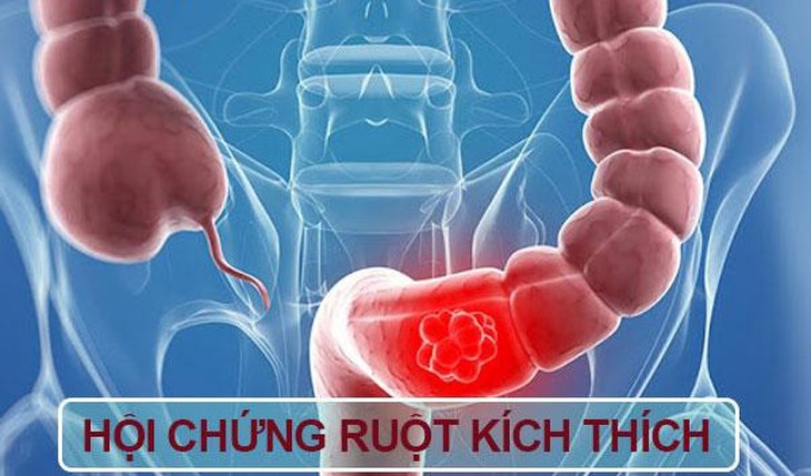 4 vị thuốc tốt cho người mắc Hội chứng ruột kích thích- Ảnh 1.