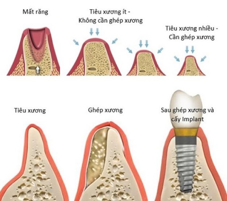 Ai cần ghép xương trong cấy ghép implant?- Ảnh 1.