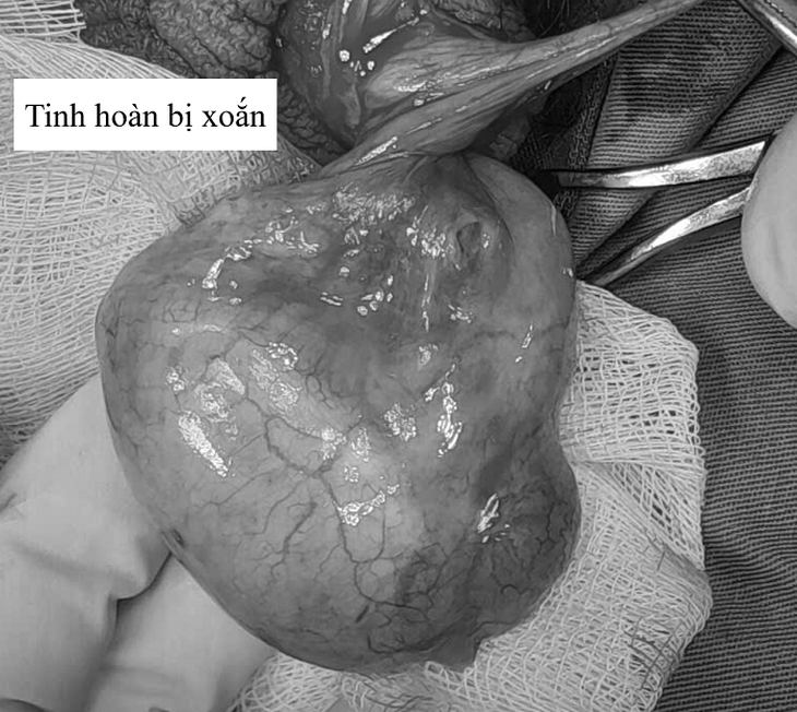 Bị xoắn tinh hoàn do va chạm trong lúc đá bóng, bác sĩ cảnh báo chấn thương nguy hiểm này- Ảnh 1. Bị xoắn tinh hoàn do va chạm trong lúc đá bóng, bác sĩ cảnh báo chấn thương nguy hiểm này- Ảnh 1.