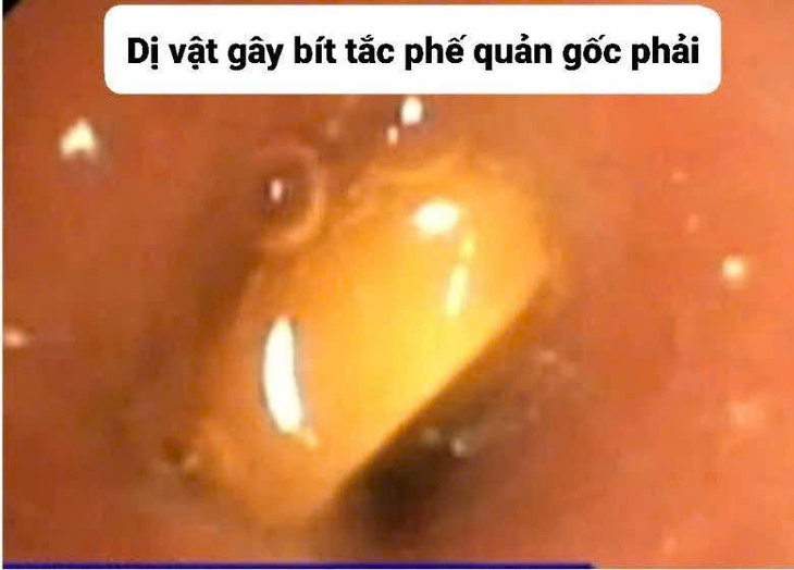 Liên tục tiếp nhận nhiều bệnh nhi hóc dị vật- Ảnh 1.