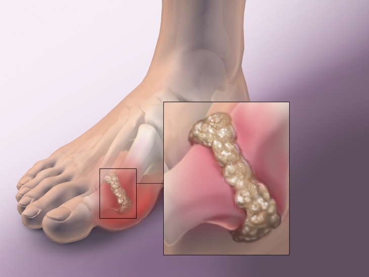 Dùng colchicin trị gout cấp tính, cẩn thận với ngộ độc thuốc- Ảnh 1. Dùng colchicin trị gout cấp tính, cẩn thận với ngộ độc thuốc- Ảnh 1.