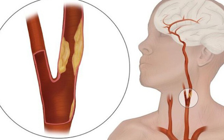 Hẹp động mạch cảnh có cần phẫu thuật không?- Ảnh 1.