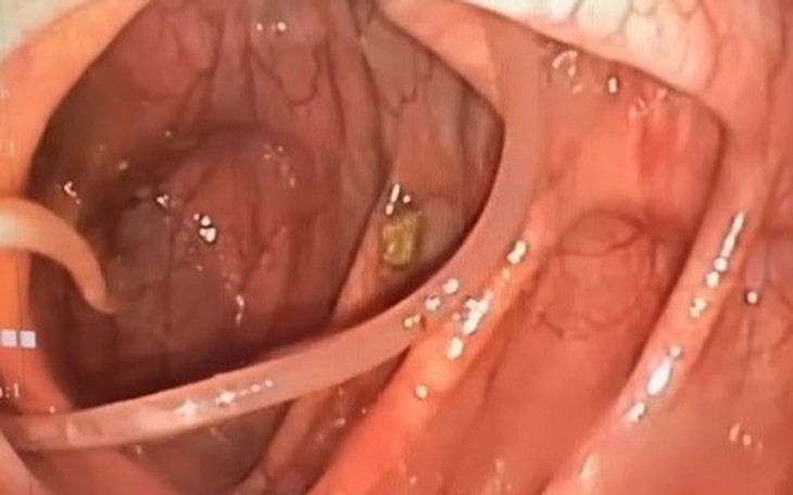 Các thói quen khiến bạn dễ mắc giun đũa và cách phòng ngừa
