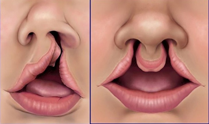 Chế độ ăn phù hợp cho trẻ bị hở hàm ếch- Ảnh 1.