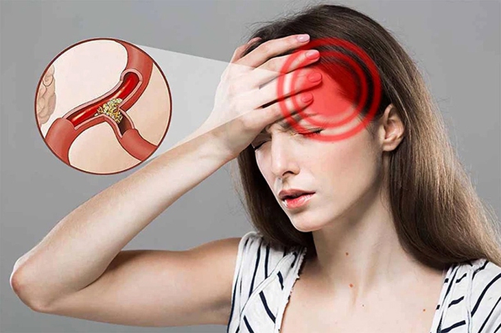 Mặc dù chưa có phương pháp điều trị thiếu máu lên não một cách triệt để song nếu điều trị tích cực cùng thay đổi lối sống, dinh dưỡng thì bệnh hoàn toàn có thể kiểm soát được. Ảnh minh họa Mặc dù chưa có phương pháp điều trị thiếu máu lên não một cách triệt để song nếu điều trị tích cực cùng thay đổi lối sống, dinh dưỡng thì bệnh hoàn toàn có thể kiểm soát được. Ảnh minh họa