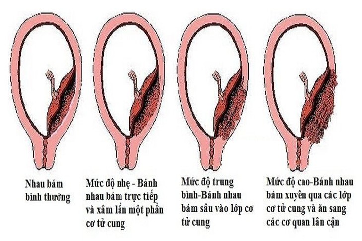 Bác sĩ vượt 100km cứu sản phụ rau cài răng lược nguy kịch- Ảnh 1. Bác sĩ vượt 100km cứu sản phụ rau cài răng lược nguy kịch- Ảnh 1.
