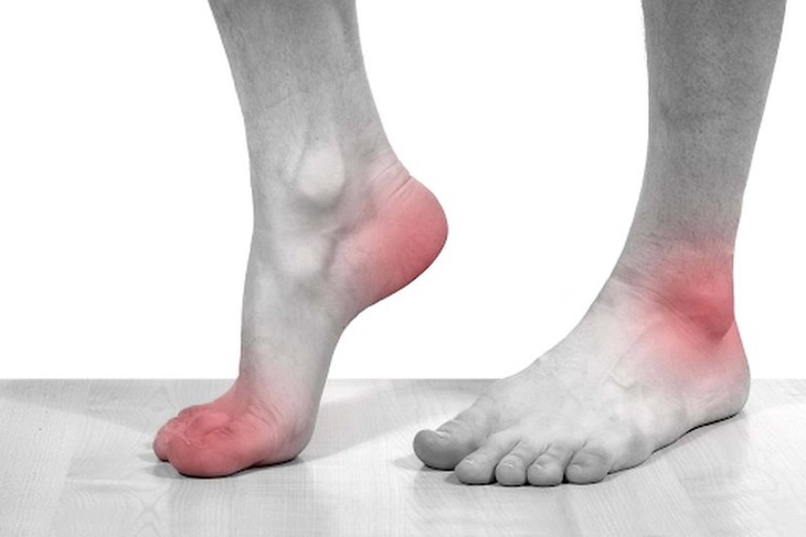 Nên ăn gì, tránh gì khi dùng thuốc trị gout colchicine?- Ảnh 1.