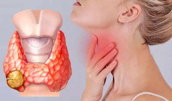 Bướu cổ đơn thuần và khối u tuyến giáp có phải là ung thư không?- Ảnh 2.