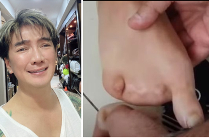 Phía Đàm Vĩnh Hưng lên tiếng về hình ảnh bàn chân bị biến dạng lan truyền trên mạng- Ảnh 1. Phía Đàm Vĩnh Hưng lên tiếng về hình ảnh bàn chân bị biến dạng lan truyền trên mạng- Ảnh 1.