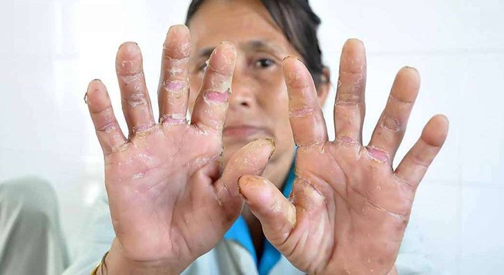 Các thuốc điều trị bệnh á sừng- Ảnh 1. Các thuốc điều trị bệnh á sừng- Ảnh 1.