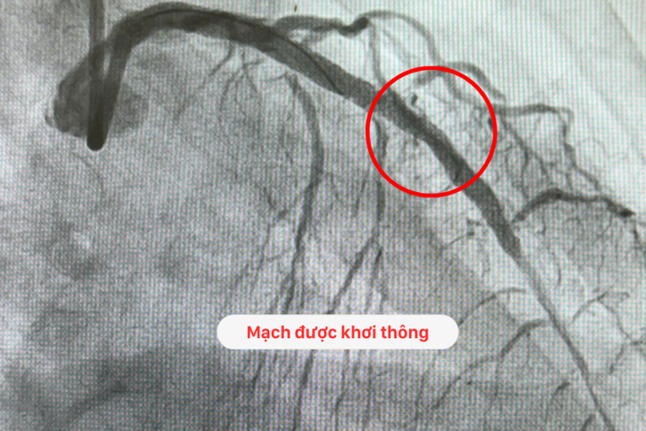 Cứu sống cụ ông 76 tuổi nhồi máu cơ tim, sốc tim, hẹp nặng 3 nhánh mạch vành- Ảnh 2. Cứu sống cụ ông 76 tuổi nhồi máu cơ tim, sốc tim, hẹp nặng 3 nhánh mạch vành- Ảnh 2.