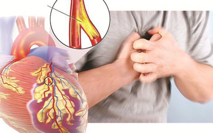 Bệnh mạch vành gây biến chứng nguy hiểm