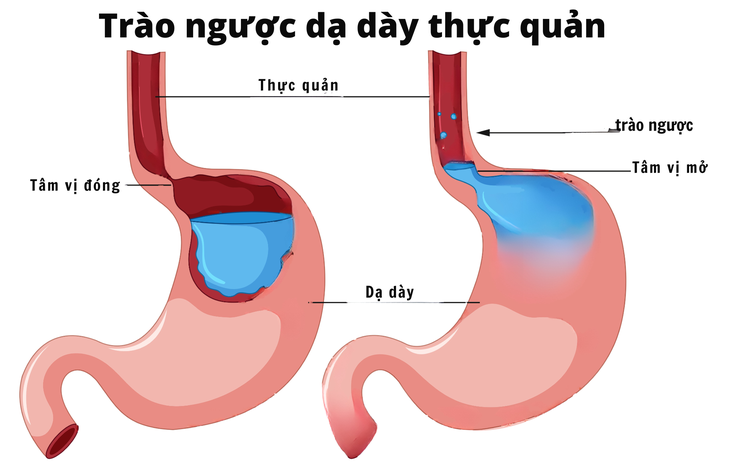 Ngăn ngừa ung thư thực quản do trào ngược bằng 'bộ đôi' Thắt tâm vị và đốt Argon Plasma- Ảnh 2.