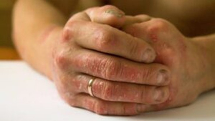 Thuốc điều trị vảy nến ở người cao tuổi- Ảnh 1. Thuốc điều trị vảy nến ở người cao tuổi- Ảnh 1.