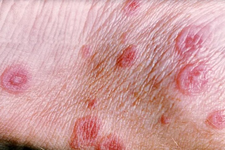 Chế độ ăn cho người bệnh hồng ban đa dạng- Ảnh 1.