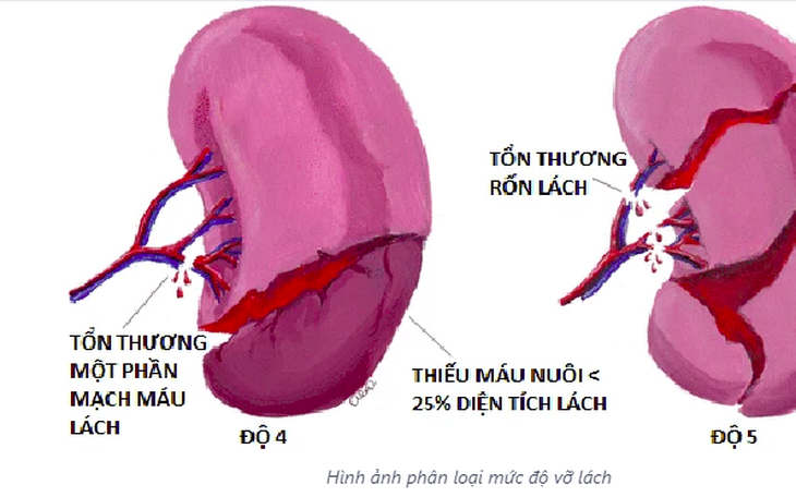 5 bài tập cơ lõi giúp ngăn ngừa chấn thương lưng - Ảnh 6.
