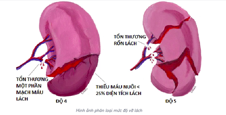 Bài tập tốt cho người sau chấn thương lách- Ảnh 1.