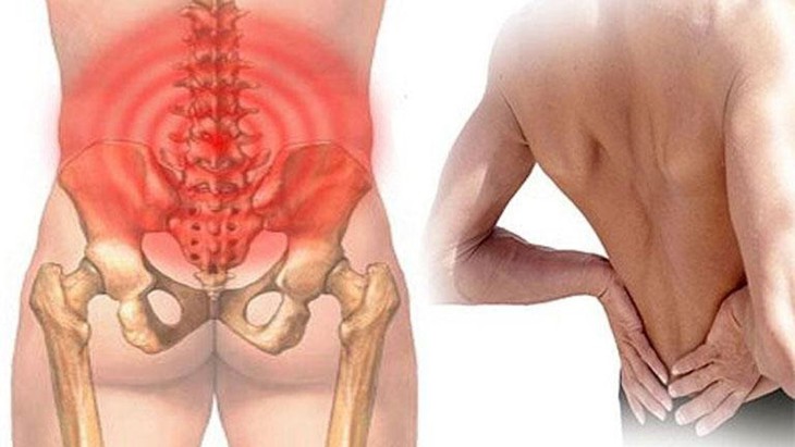 Gai cột sống: Nguyên nhân, biểu hiện, cách điều trị và phòng bệnh- Ảnh 1.