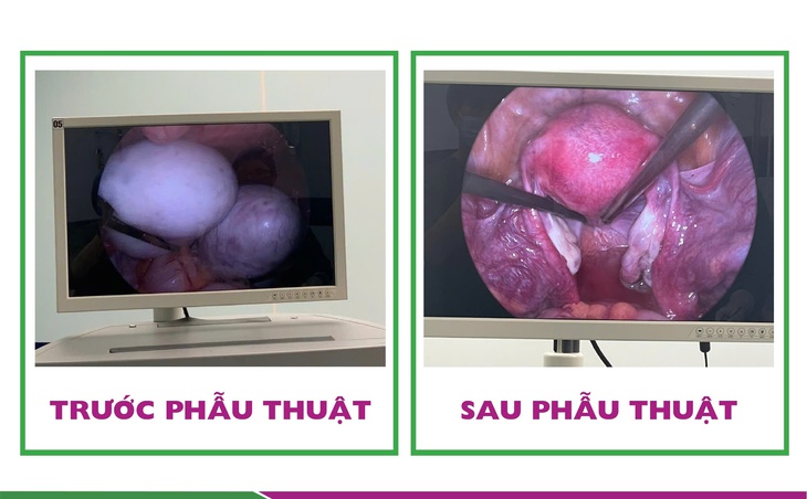 Bụng to bất thường, thiếu nữ 20 tuổi nhập viện với 2 u bì buồng trứng kích thước lớn - Ảnh 2. Bụng to bất thường, thiếu nữ 20 tuổi nhập viện với 2 u bì buồng trứng kích thước lớn - Ảnh 2.