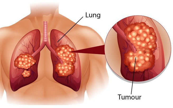 Ung thư phế quản phổi nguyên phát: Nguyên nhân, triệu chứng, cách điều trị và phòng bệnh