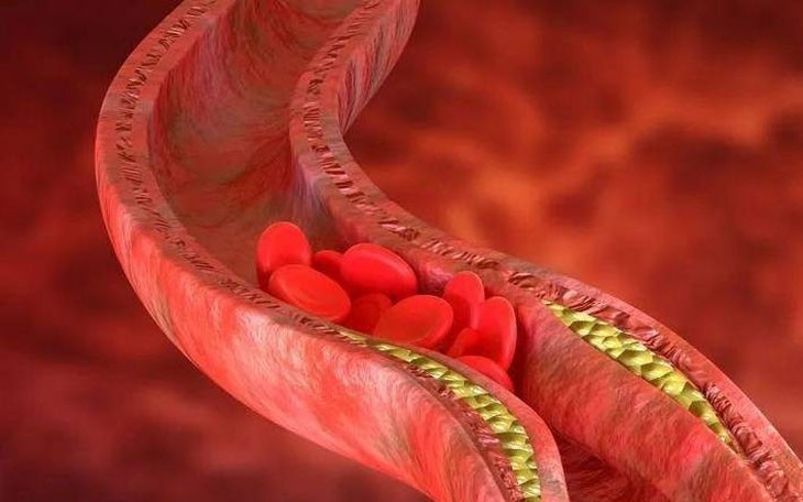 Huyết khối: Nguyên nhân, biểu hiện, cách điều trị và phòng bệnh