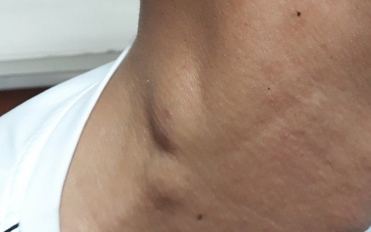 Lao hạch: Nguyên nhân, triệu chứng, phòng ngừa và điều trị