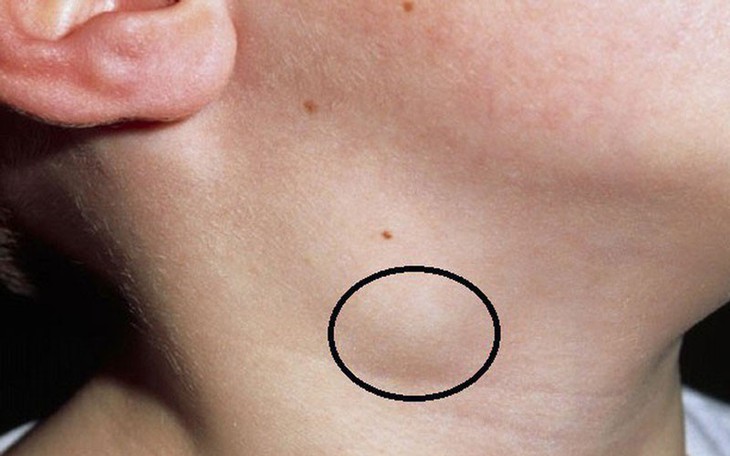 Câu hỏi thường gặp về lao hạch