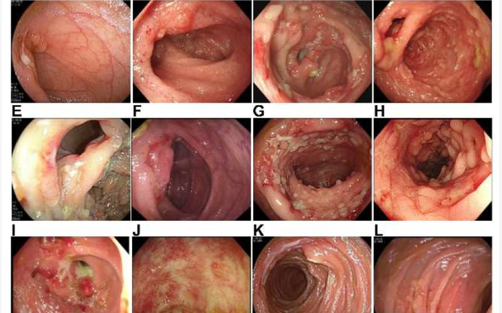 Lao ruột: Nguyên nhân, triệu chứng, phòng ngừa và điều trị