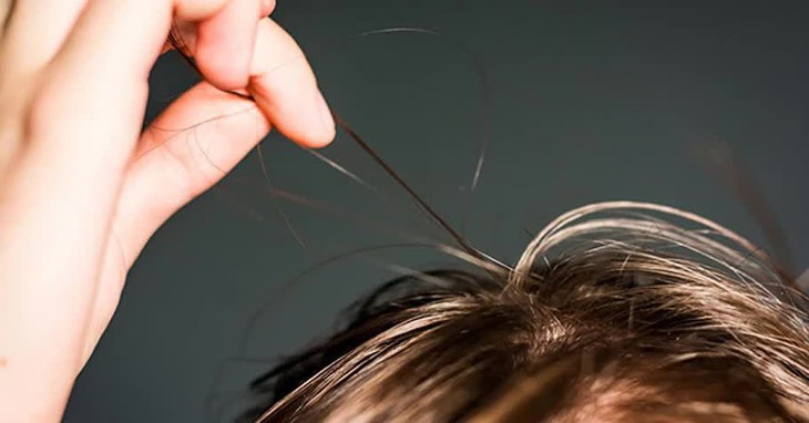 Hội chứng nghiện giật tóc: Nguyên nhân, biểu hiện, cách điều trị và phòng bệnh- Ảnh 1. Hội chứng nghiện giật tóc: Nguyên nhân, biểu hiện, cách điều trị và phòng bệnh- Ảnh 1.