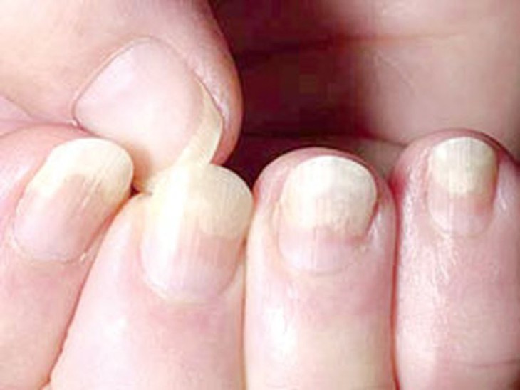 Tập luyện cho người mắc Hội chứng móng và xương bánh chè- Ảnh 1. Tập luyện cho người mắc Hội chứng móng và xương bánh chè- Ảnh 1.