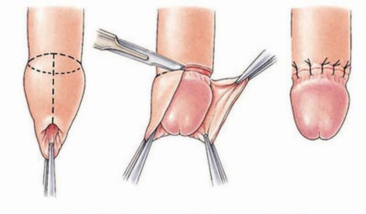 Thủ thuật cắt bao quy đầu có rủi ro và biến chứng tiềm ẩn gì?- Ảnh 1.