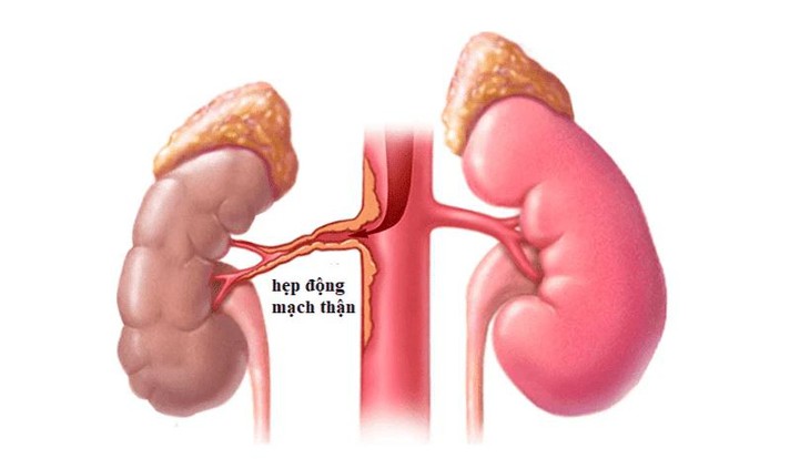 Hẹp động mạch thận: Nguyên nhân, biểu hiện, cách điều trị và phòng bệnh- Ảnh 1. Hẹp động mạch thận: Nguyên nhân, biểu hiện, cách điều trị và phòng bệnh- Ảnh 1.