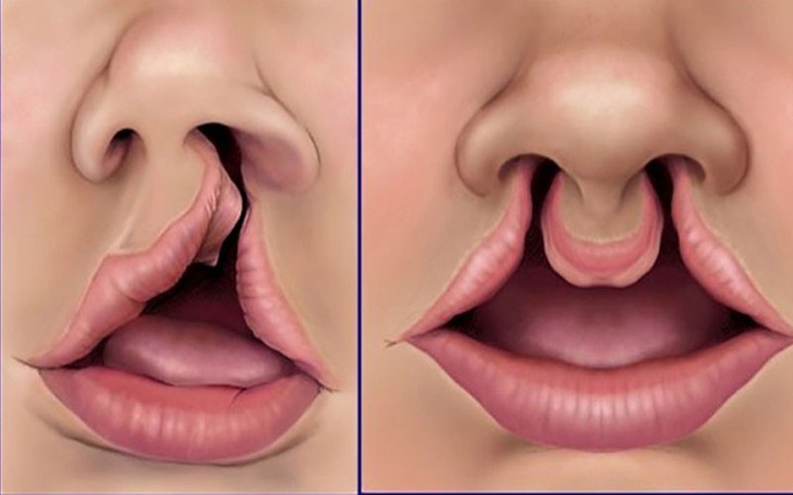 Hở hàm ếch: Nguyên nhân, biểu hiện, cách điều trị và phòng bệnh