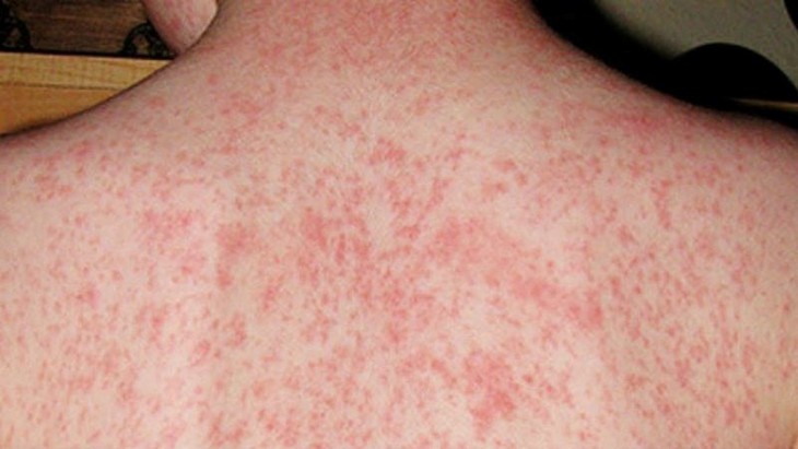 Khánh Hòa: Lập 2 tổ công tác đốc thúc tiêm vaccine phòng bệnh sởi- Ảnh 1. Khánh Hòa: Lập 2 tổ công tác đốc thúc tiêm vaccine phòng bệnh sởi- Ảnh 1.