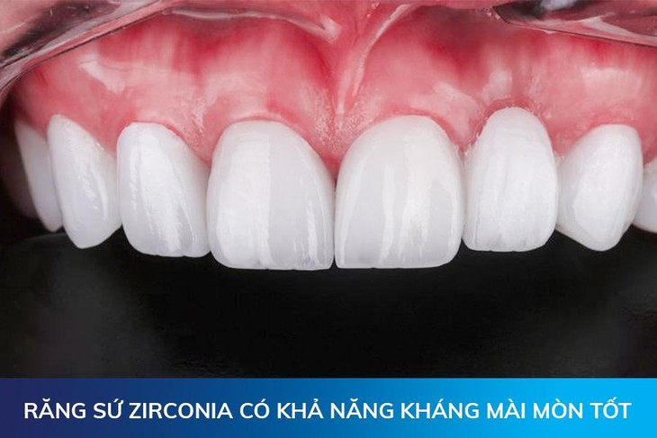 Hướng dẫn cách vệ sinh răng sau khi bọc răng sứ- Ảnh 2.
