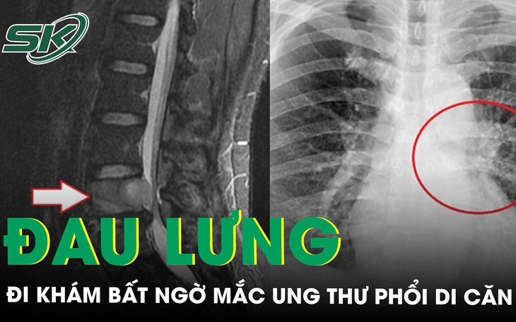 Đi khám tưởng đau lưng hóa ung thư phổi di căn